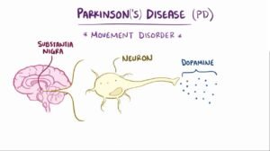 stages of Parkinson's disease